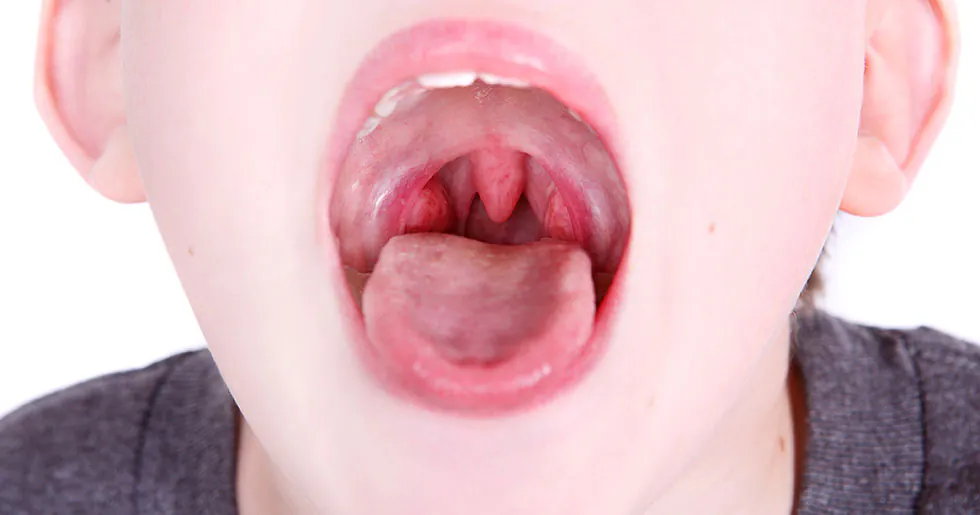 Cirurgia de amígdalas e adenoide - Dra. Lara Pascoutto Sampaio